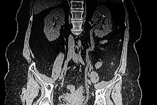 Medical themes: Abdominal tomography showing bilateral renal lithiasis. Bilateral hydronephrosis