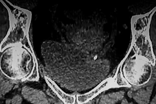 Medical themes: Abdominal tomography showing bilateral renal lithiasis. Bilateral hydronephrosis
