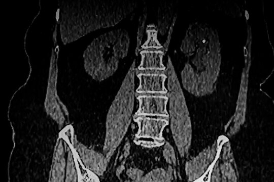 Medical themes: Abdominal tomography showing bilateral renal lithiasis. Bilateral hydronephrosis