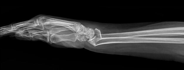 Plain radiograph of wrist in lateral projection on dark background . The film shown comminuted fracture of distal radius and ulnar in patient at emergency room suffer form fall.Osteoporosis.