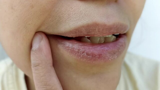 Close up of dry lips of an Asian female. Extremely dry cause of an allergies due to use of beauty products or due to the weather.