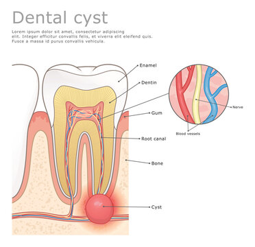 Dental cyst medical vector illustration labeled. 
