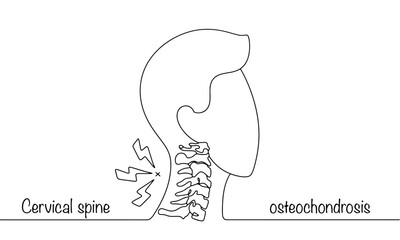 Cervical spine osteochondrosis