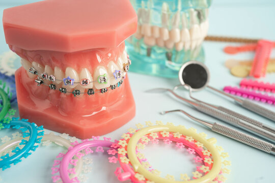 Orthodontic ligatures rings and ties, elastic rubber bands on orthodontic braces, model for dentist studying about dentistry.