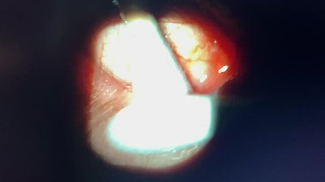 Medical scope view of meibomian gland expression in doctor's office