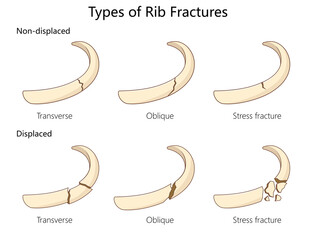types of rib fractures, non-displaced and displaced fractures, transverse, oblique, stress fracture examples diagram hand drawn schematic raster illustration. Medical science educational illustration © Oleksandr Pokusai