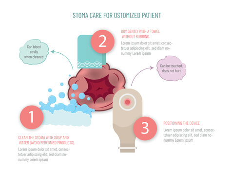 Visual guide for stoma care in ostomized patients, including cleaning, drying, and positioning of the device.