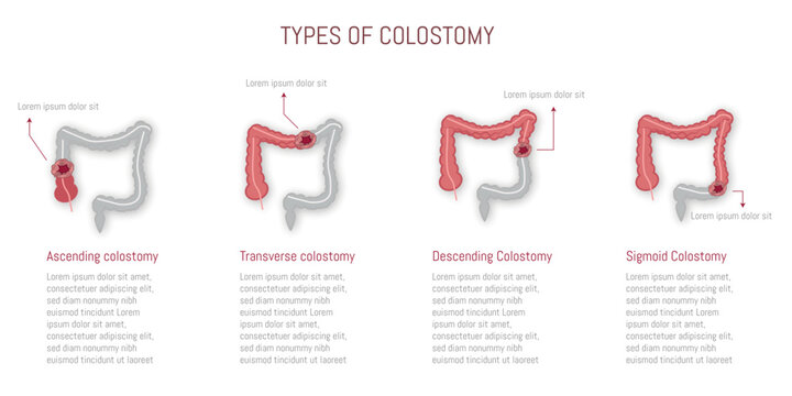 Illustration of different types of colostomy: ascending, transverse, descending, and sigmoid.