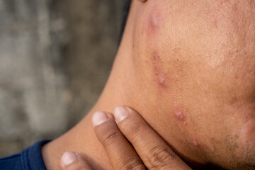 Naklejka premium close-up of a male model showing acne growing on the neck and cheeks with a face with rough or large pores like orange peel.men's facial care concept
