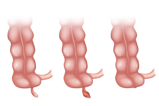 Appendicitis is an inflammation of the appendix. is an inflammation of the appendix. Appendicitis Treatment Surgery. Appendectomy. Laparoscopic Appendix Removal   