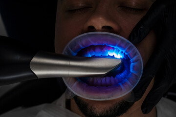 Digital impressioning teeth of patient with 3d digital dental scanner. Dental 3d scanner applying process.