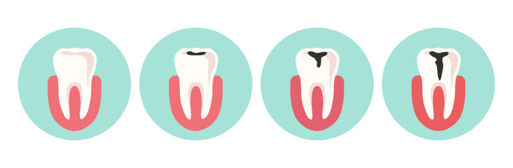 Stages of caries development. Vector illustration.