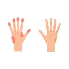 手湿疹と汗疱のよく発症する部位のイメージイラスト（女性の手）