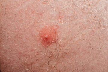 Fototapeta premium pimple on the body