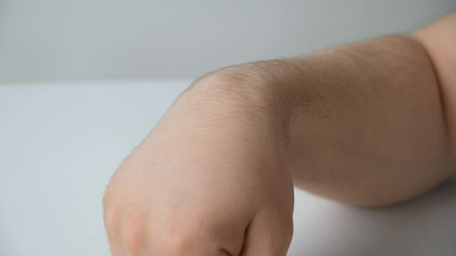 Ganglion cyst or hygroma of the wrist on the hand of a male patient, the process of flexion of the wrist joint.