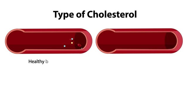 Cholesterol Types and Blood Vessel Health