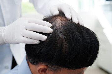 Fototapeta premium Doctor touch bold head in man, hair loss treatment health problem.