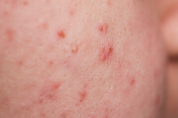 Skin acne background. Closeup acne pimple. Treatment for acne skin. Problem skincare. Pimples,...