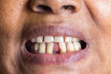 Close up of the teeth of a woman with a broken tooth.