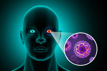 Visual concept of Bacterial conjunctivitis. 3d illustration