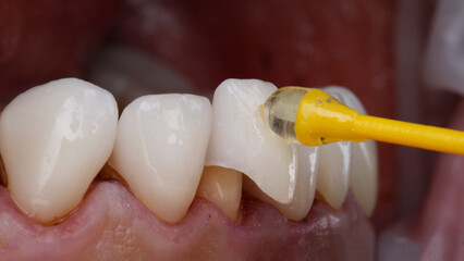 a beautiful moment of gluing the installation of a ceramic veneer on the lower jaw using a sticky brush