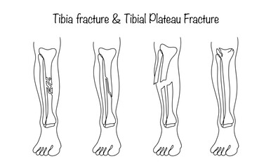 Tibia fracture