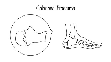 Calcaneal fractures