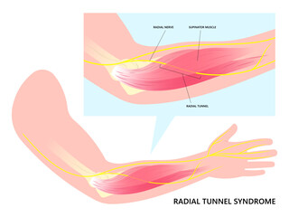 Arm anatomy with Radial tunnel syndrome and compressed nerve of Tinel's or Golfer's disease