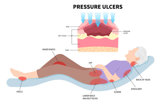 Bedsores or pressure ulcer of the skin tissue injury