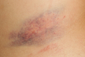 Close up view of a nasty bruise