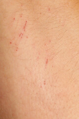 Fototapeta premium Close up view of a nasty bruise