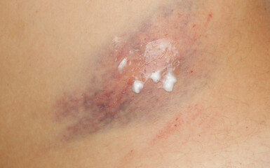 Close up view of a nasty bruise