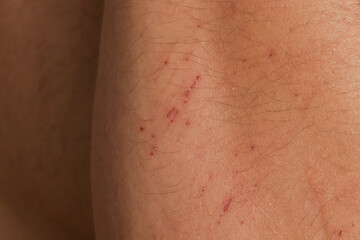 Close up view of a nasty bruise