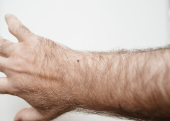 A close-up view of a tick embedded in the forearm of a man's arm, highlighting the need for caution...