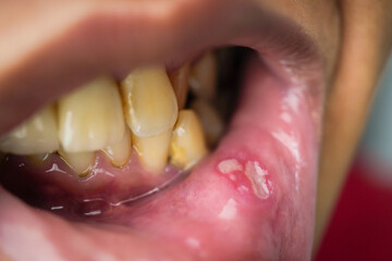 Close-up photo of the inner lip of a man suffering from a canker sore and teeth with a lot of...