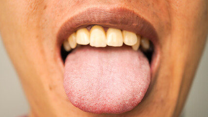 Close-up photo of a man sticking his tongue out, showing the detailed papillae on the tongue's...