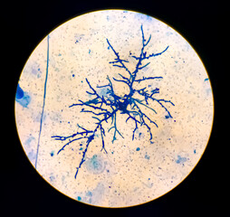 Candida Albicans yeast cell, pseudo hyphae with spores. Pseudohyphae from sputum by methylene blue...