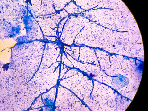 Microscopic fungi Malassezia furfur, showing yeast cells and hyphae. dermatophytes, Nail scraping or skin scraping for fungus test in microbiology laboratory