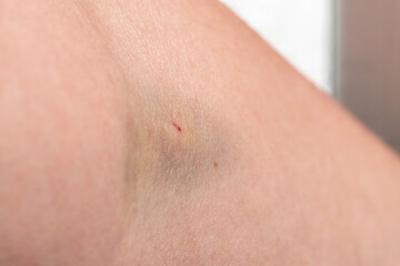 A human hand with a hematoma and traces of injections into a vein