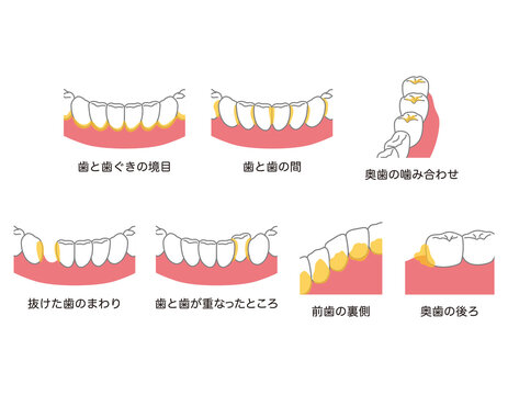 歯に溜まった歯垢　歯磨き　磨き残し