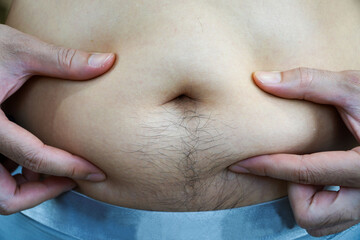 Fototapeta premium Obese man has a diseased belly, Fat man holding excessive fat belly,food choice concept