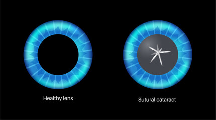 Cataract eye disease