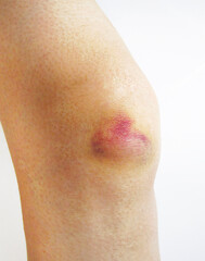 Bruise on Knee from Injury – Close-up of Human Leg Contusion（脚の膝にできた打ち身の怪我のあざ）