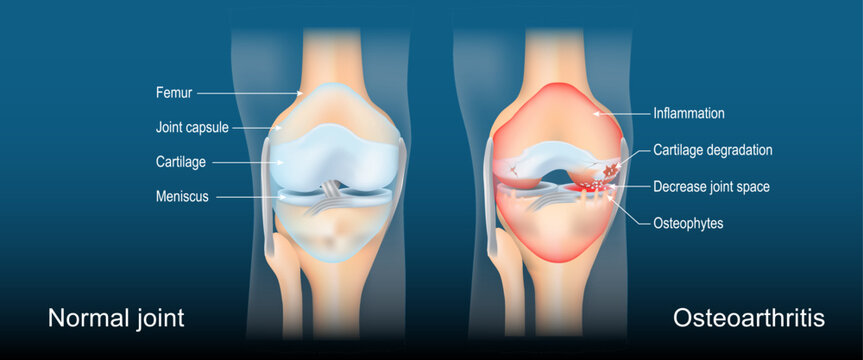 Osteoarthritis. Arthritis. Degenerative joint disease.