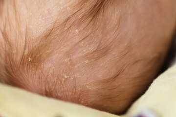 Pieces of dry skin on the head of a baby. Seborrheic dermatitis closeup