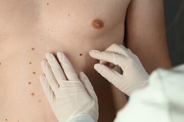 Dermatologist in gloves examining patient's birthmark, closeup