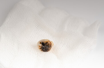 The extracted tooth is on a white gauze, Dental surgery concept, Macro photograph of a pulled tooth, with a gauze pad.