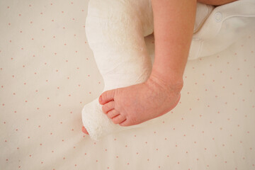 Newborn little baby with leg in a cast - clubfoot, close-up.