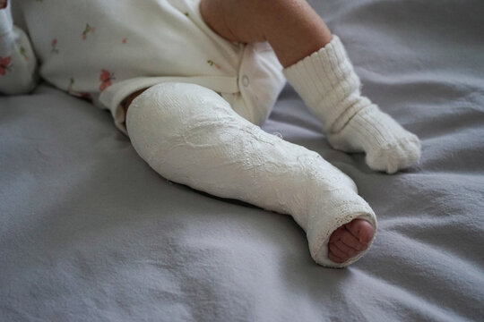 Newborn little baby with leg in a cast - clubfoot, close-up.