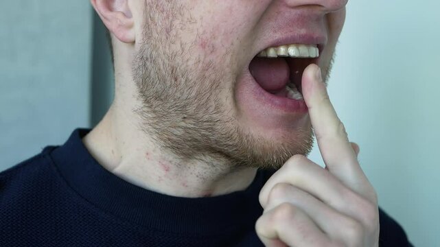 Place the aligner on your teeth. A man with a mouthguard in his teeth. Transparent protector for teeth against broken fillings. Jaw alignment.